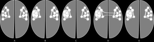 compensatory right hemisphere (E) Torres et al., 213 Turkeltaub et al.