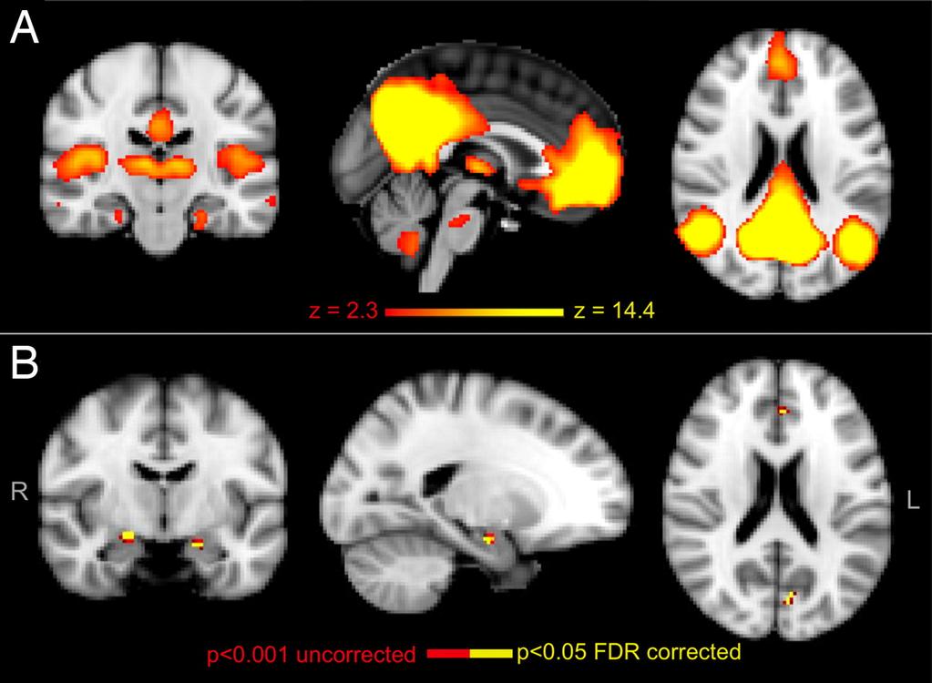 Increased DMN Connectivity in Young E4 Carriers Filippini et al.