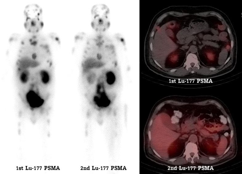 Chula case: Lu-177 PSMA 1 st dose PSA