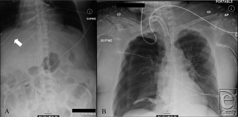 Interesting Case Series Pulmonary Injury Secondary to Feeding Tube Misplacement Thomas R. Resch, MD, Leigh A. Price, MD, and Stephen M.