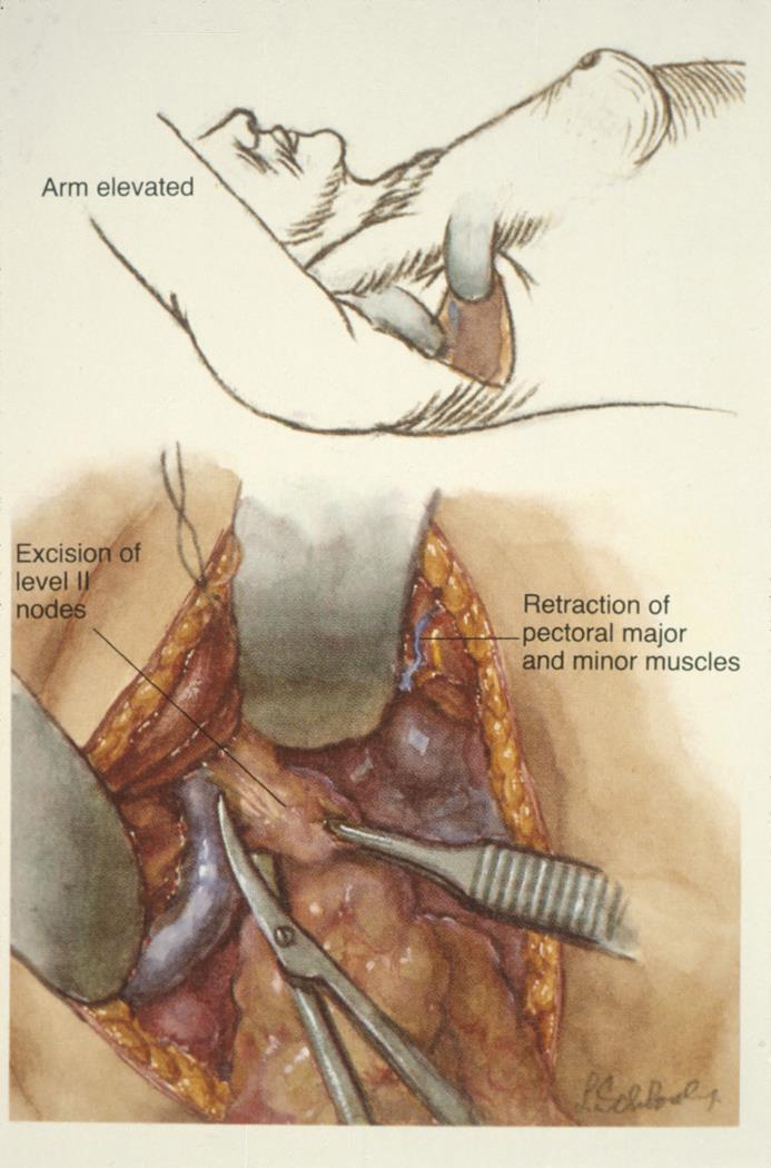 The Axilla Lymph nodes Some patients will still need an axillary clearance: