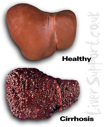 Liver Cirrhosis The liver is overgrown with extra tissue which cuts down blood flow and lowers its