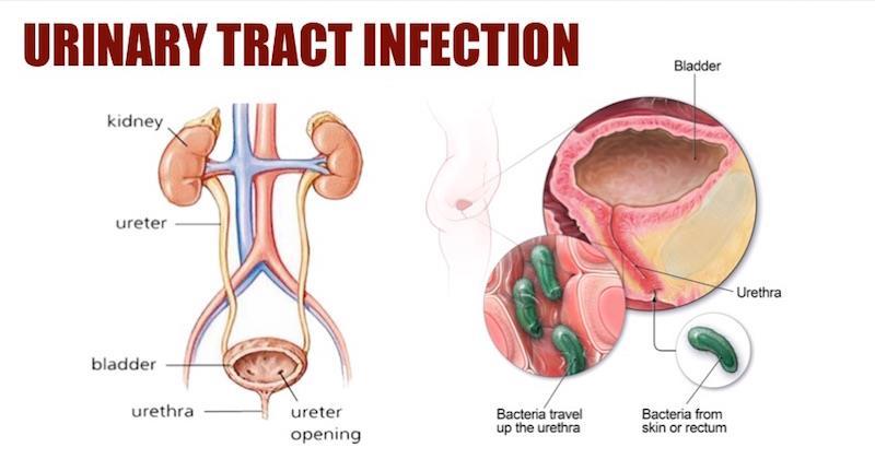 Urinary Tract Infection (UTI) Bacteria enters the