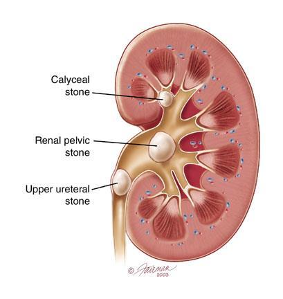 Kidney Stones Substances can crystallize out of urine in the urinary tract or kidney.