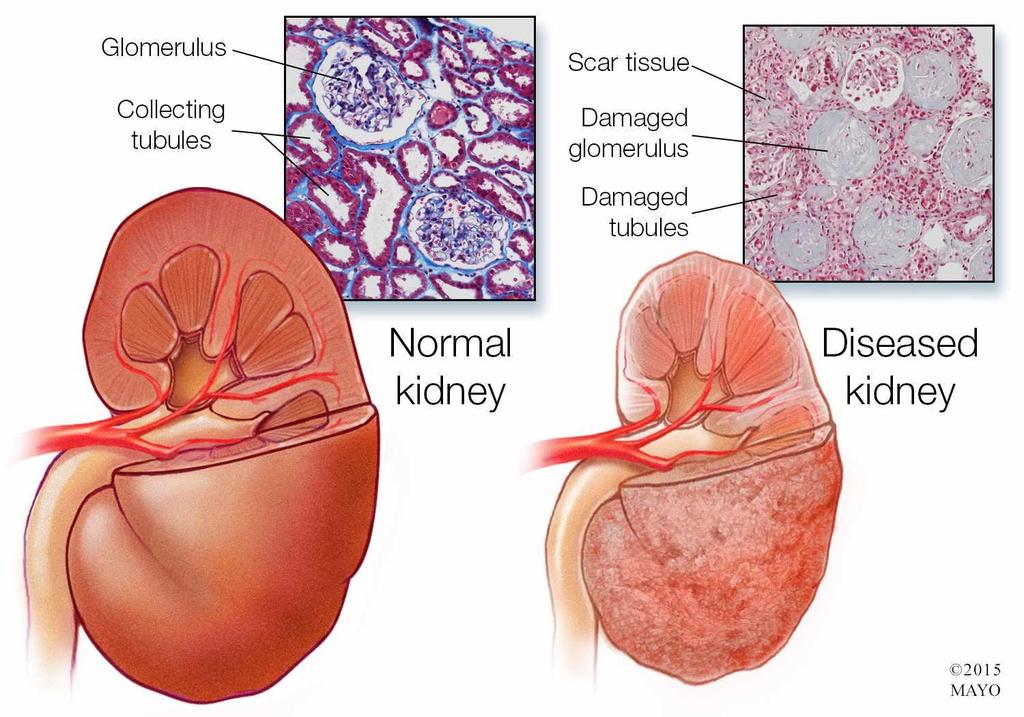 What could cause kidney