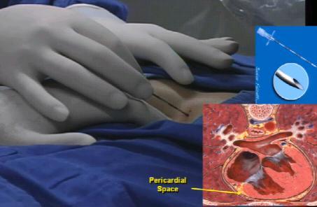 Subxyphoid pericardial space acces Avoid perfuration of