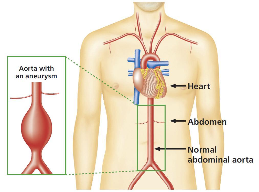 Abdominal aortic aneurysm screening The aorta is the main blood vessel that supplies blood to your body. It runs from your heart down through your chest and abdomen.