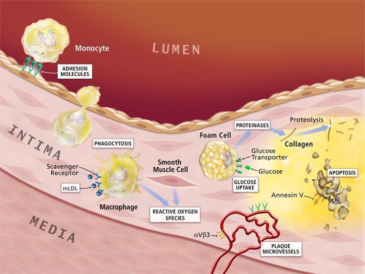 THIS IS WHAT HAPPENS Starts with damage to the endothelial cell in the wall of the artery Substances begin to enter the damaged area (including LDL) Chemical reactions lead to the oxidation of the