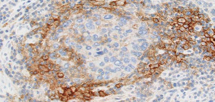 Membrane and Cytoplasmic Staining: Tumor-associated Mononuclear Inflammatory Cells (MICs) Tumor-associated lymphocytes and macrophages (mononuclear inflammatory cells, MICs) exhibiting convincing