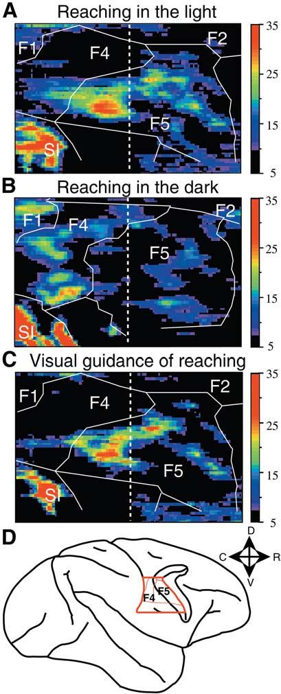 For the geometrical normalization of the ventral premotor maps we Fig. 3. Activations in the ventral premotor cortex induced by reaching in the light and reaching in the dark.