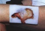 Under treatment with LIGASANO white wound dressing Fig. 1.4.