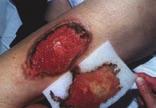 be grafted with split skin graft Fig. 1.5. After transplantation of the graft.