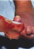 Case 7 61 years old, male, with diabetic foot (Charcot