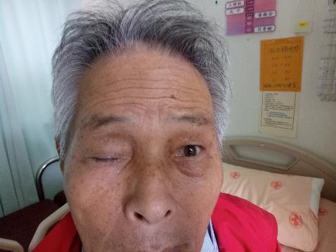 Right ptosis 70 y/o male Nausea and vomiting Sudden onset of blurred vision,