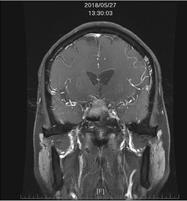 MRI brain 4cm heterogeneous enhancement