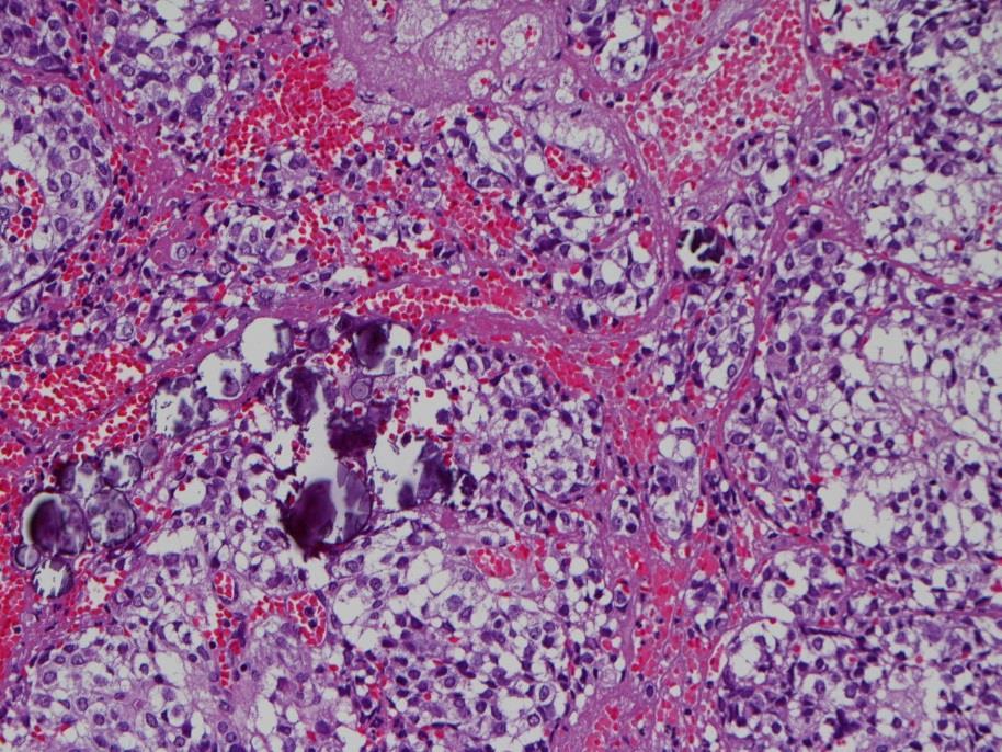 fluid inside the tumor, c/w apoplexy) (D4) Levothyroxine