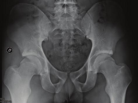 2 Case Reports in Orthopedics Figure 1: AP view of both hips showed a large superior rim fracture.