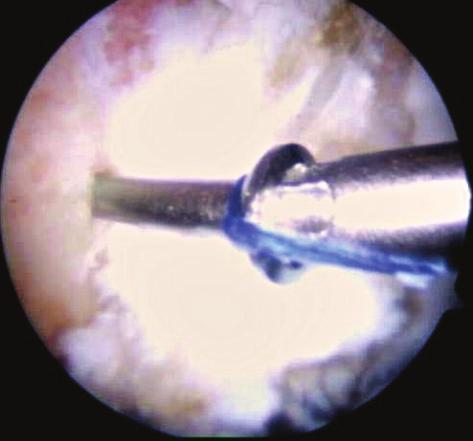 A labral tear associated with a large superior fracture of the bone rim was found; the cartilage at the junction with the labrum was intact in both hips.