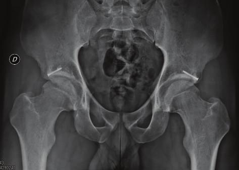 This was performed under X-ray supervision and the remaining bone fragment was secured with an arthroscopic assisted 3.0 mm cannulated screw (Figure 3) in both sides.