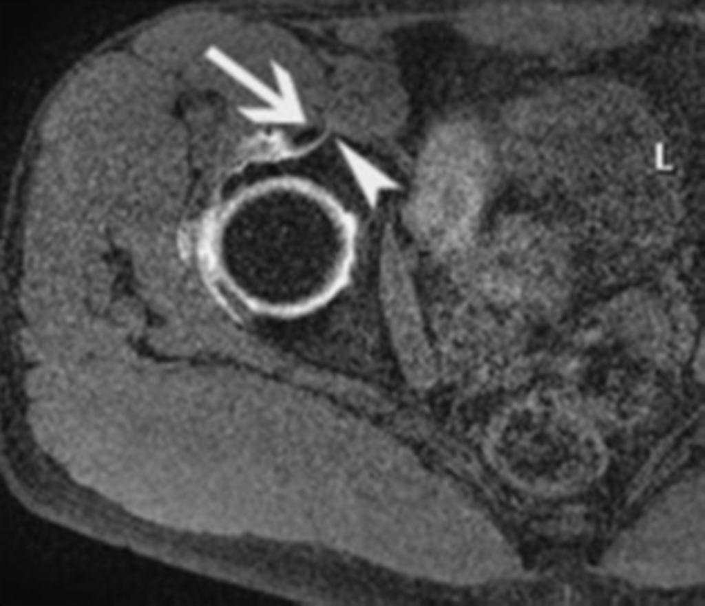 Fig. 6: Rectus Femoris tendinopathy:axial STIR image showing fluid