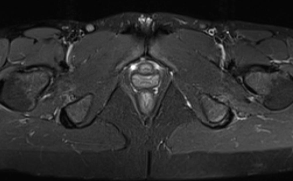 Fig. 7: Common Hamstring tendon origin tendinopathy: Axial STIR image showing high signal