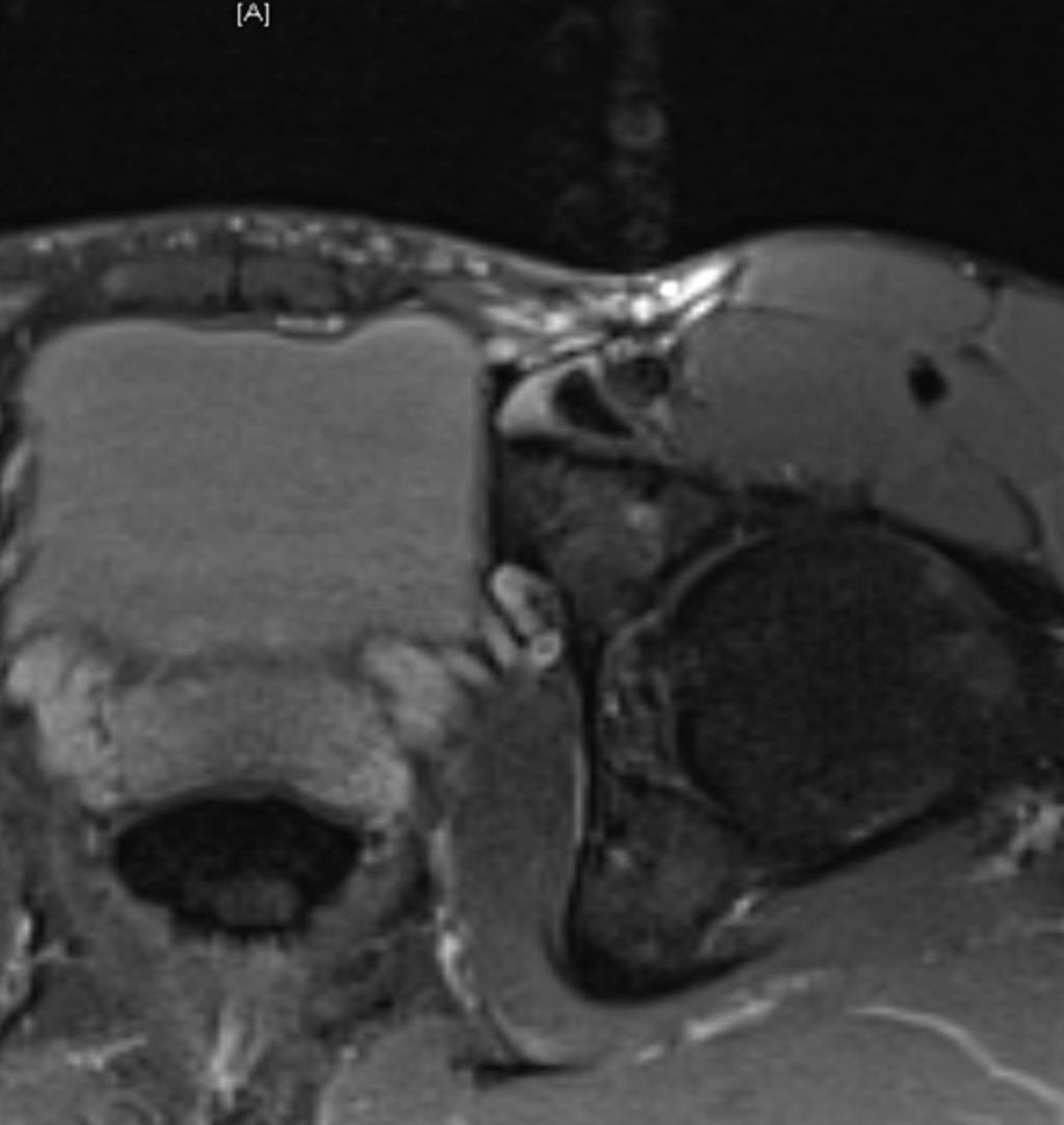 Fig. 8: Ileopsoas Bursitis: Axial STIR image showing high signal fluid
