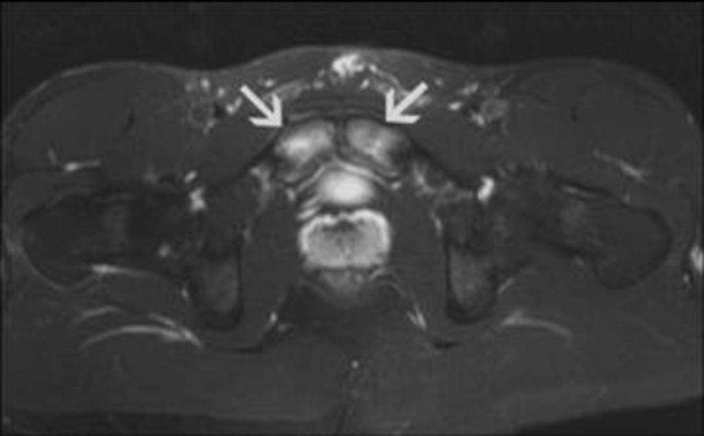 Fig. 9: Osteitis pubis: Axial STIR image showing juxta-articular pubic