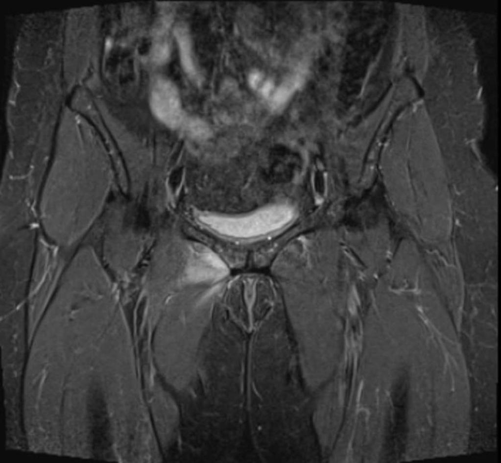 Fig. 10: Adductor tendon strain: Coronal STIR image showing high signal oedema