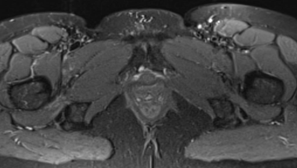 Fig. 11: Ischiofemoral Impingement: Axial STIR image showing high signal oedema in the