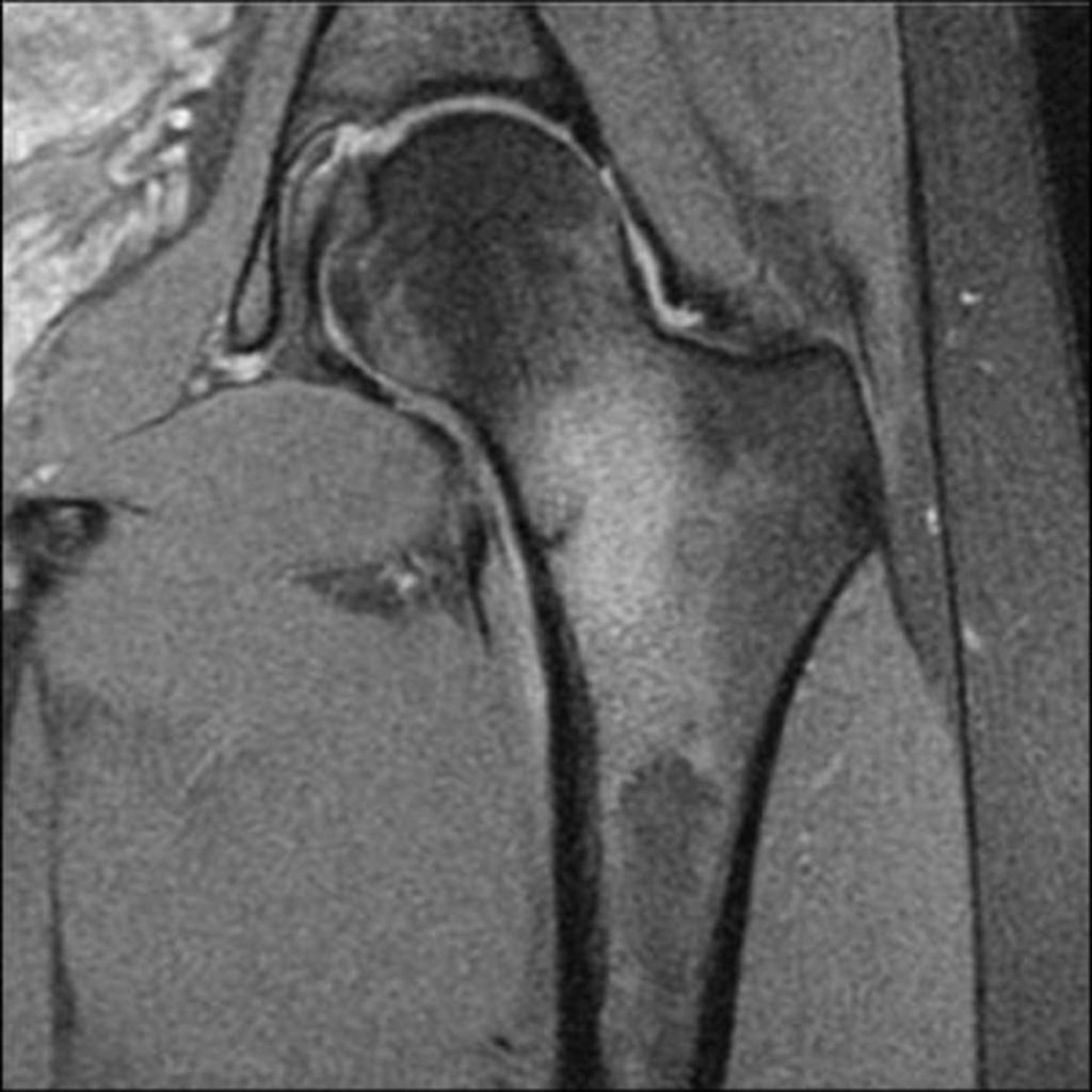 Fig. 12: Femotral neck stress fracture: Coronal STIR image showing a low signal fracture line extending