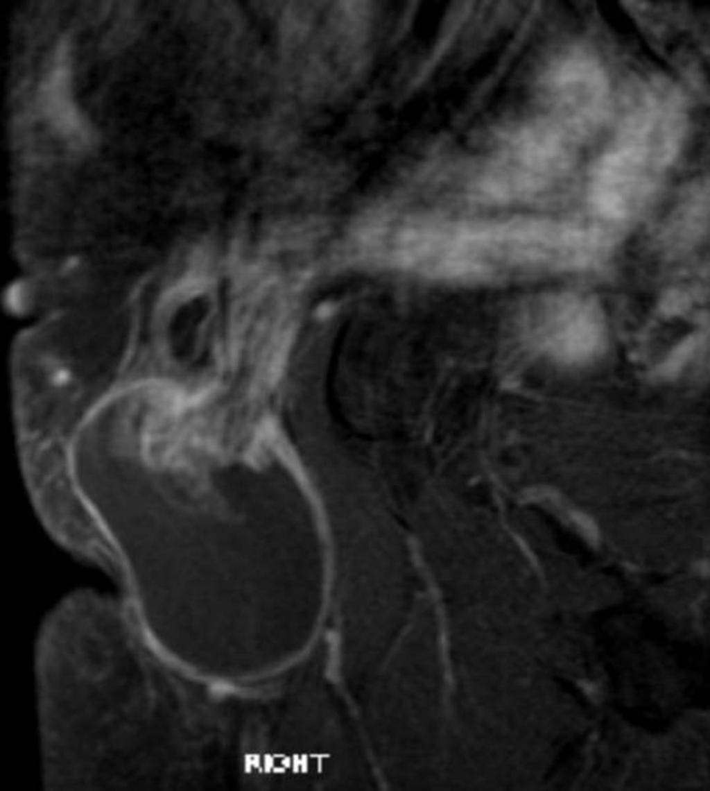 Fig. 13: Inguinal Hernia: Coronal STIR image demonstrating a right sided indirect