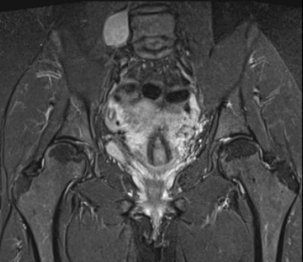 Fig. 14: Nerve Root Impingement: Coronal STIR MRI demonstrating a normal