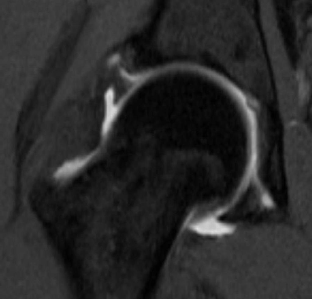 Fig. 4: Coronal T1 weighted MR arthrogram with fat suppression shows triangular labrum avulsed