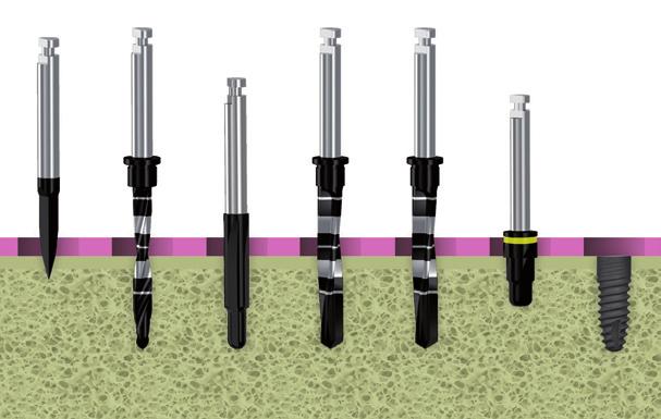 GMI DRILLING SEQUENCES The GMI implant system drilling sequences and the recommended conditions for use are as follows: Lance-shaped drill: 1200-1500 rpm. Pilot drill: 900-1200 rpm.