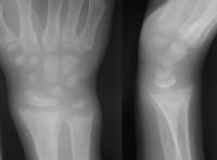 Classic radiographic findings include: widening of the distal epyphysis, fraying and widening of the