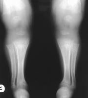 Anteroposterior and lateral radiographs of the wrist of an 8year-old boy with rickets demonstrates