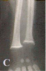 Rickets in 3 month old infant (B) Healing after
