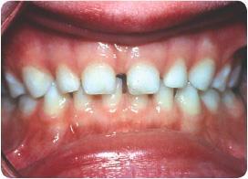 Often referred to as baby teeth. Primary Teeth Have thinner enamel, are smaller and appear whiter (translucent/- almost bluish) than permanent teeth.