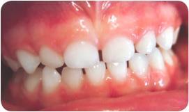 Normal Healthy Teeth Teeth should be white with smooth surfaces.