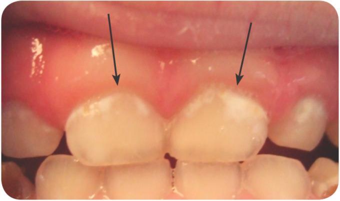White Spot Lesions First appear as dull white bands, along the smooth surface of the tooth at the gum line, followed by yellow or brown discoloration. These are first signs of decay.