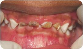 Rampant Decay Refers to the presence of multiple cavities in several teeth.