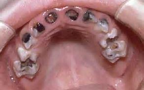 Early Childhood Caries (ECC) A transmissible infectious disease that affects children