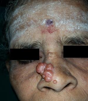 4. Discussion References Skin adnexal tumors (SAT) are derived from primordial germ cells which can exhibit varying morphological differentiation towards one of the different types of adnexal