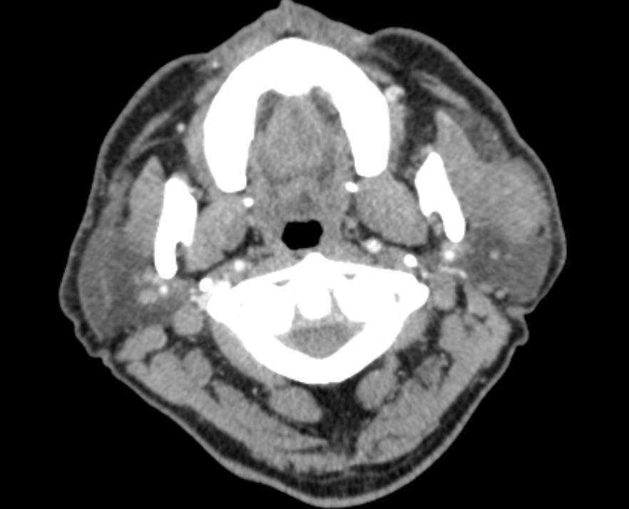 mss Axial, contrast computed tomography P: Parotid gland mss: masseter