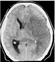 Ischemic brain swelling Associated with astrocytic ischemia Cytotoxic edema Peak swelling usually day 2-3