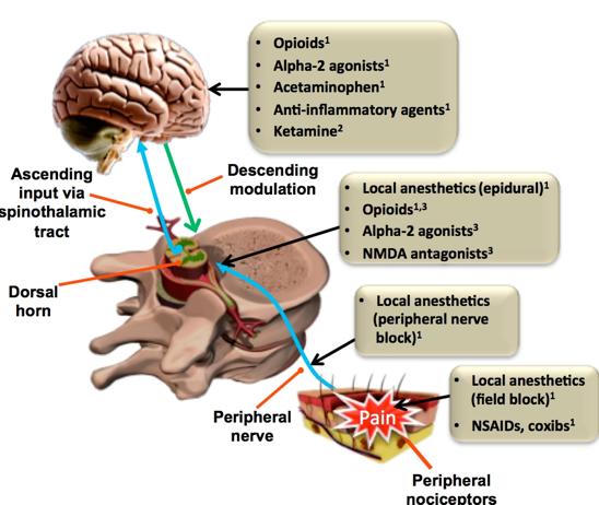 Multimodal Analgesia Options for Multimodal Analgesia ample Multimodal Approach Utilization of more than 2 analgesics which act at different sites in CN and PN Goal to Minimize pain as well as