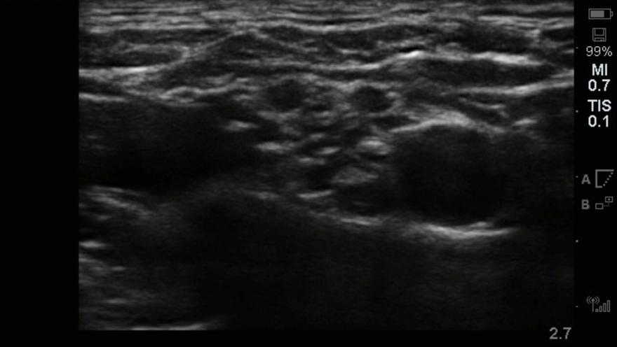 below shoulder level Blocks brachial plexus at level of divisions Misses suprascapular nerve (60-70% of shoulder) Risk of Pneumothorax