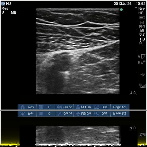 Literature upport Other Brachial Plexus Blocks Adductor Canal Gamo et al: upraclavicular block permitted operating conditions without general in 99.5% of cases and 96.