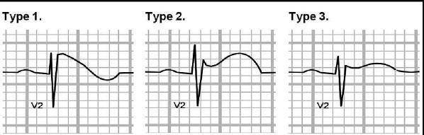Diagnostic criteria of BS Ajmaline Type 1 ST segment elevation 2 mm in > 1 right precordial lead (V1-3) spontaniously or after sodium-blocker