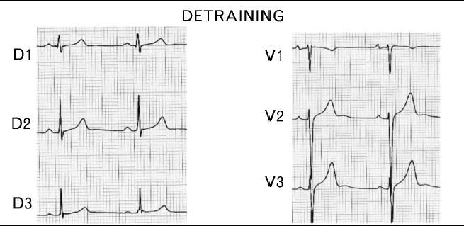 (460/470 500 ms) and asymptomatic Deconditionering Repeated ECGs Holter